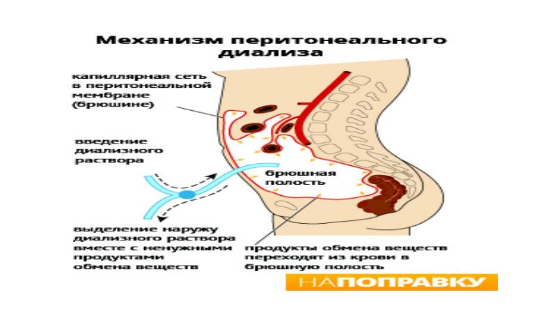 Перитонеальный диализ презентация