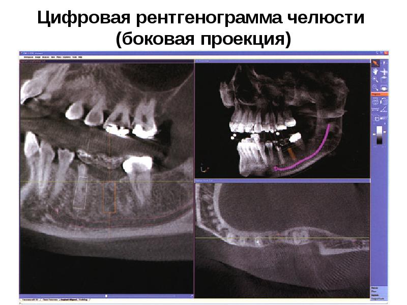 Остеопороз челюсти фото