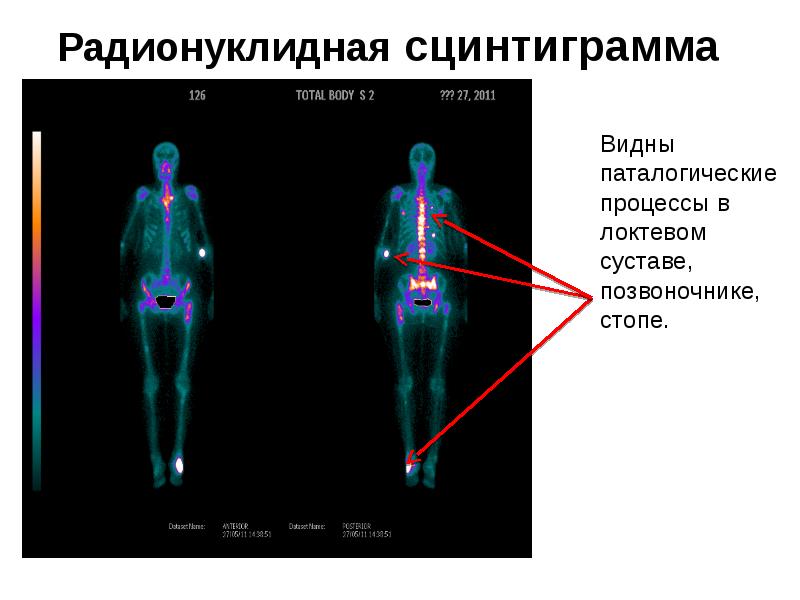 Сцинтиграмма является изображением