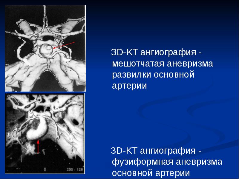 Форум аневризма мозга. Аневризма бифуркации основной артерии. Аневризма основной артерии на кт. Аневризма развилки основной артерии головного мозга.