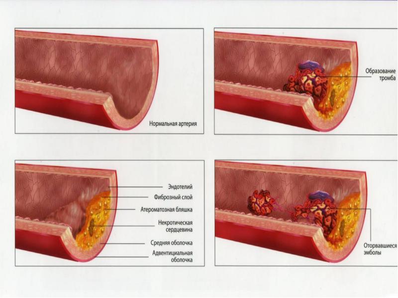 Картинки атеросклероз сосудов презентация