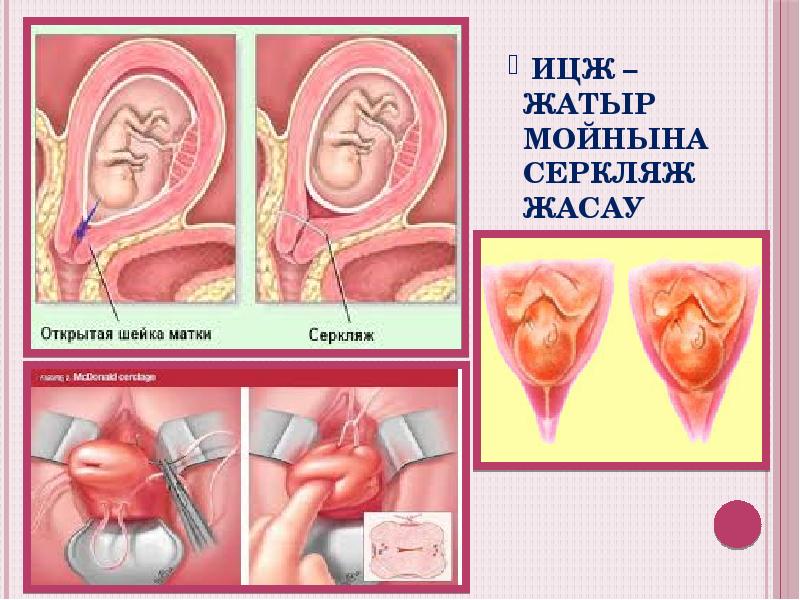 ИЦЖ – жатыр мойнына серкляж жасау ИЦЖ – жатыр мойнына серкляж жасау