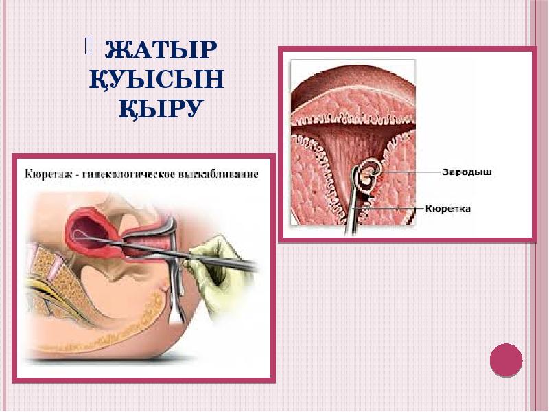 Жатыр қуысын қыру Жатыр қуысын қыру