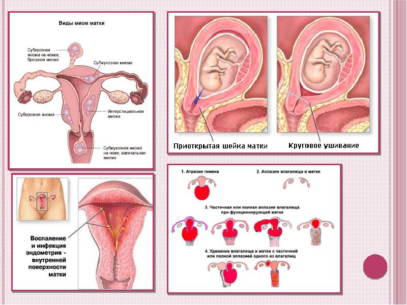 Воспаление матки у женщин симптомы и лечение. Острое воспаление матки.