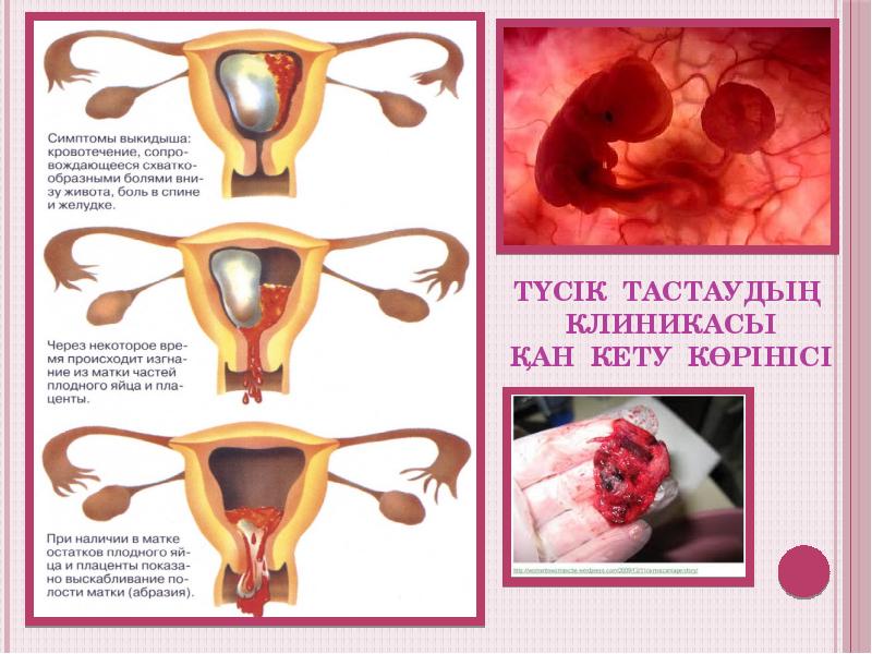 Түсік тастаудың клиникасы қан кету көрінісі Түсік тастаудың клиникасы қан кету көрінісі