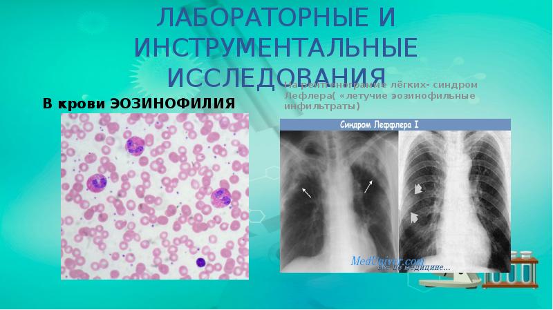 ЛАБОРАТОРНЫЕ И ИНСТРУМЕНТАЛЬНЫЕ ИССЛЕДОВАНИЯ
В крови ЭОЗИНОФИЛИЯ ЛАБОРАТОРНЫЕ И ИНСТРУМЕНТАЛЬНЫЕ ИССЛЕДОВАНИЯ
В крови ЭОЗИНОФИЛИЯ