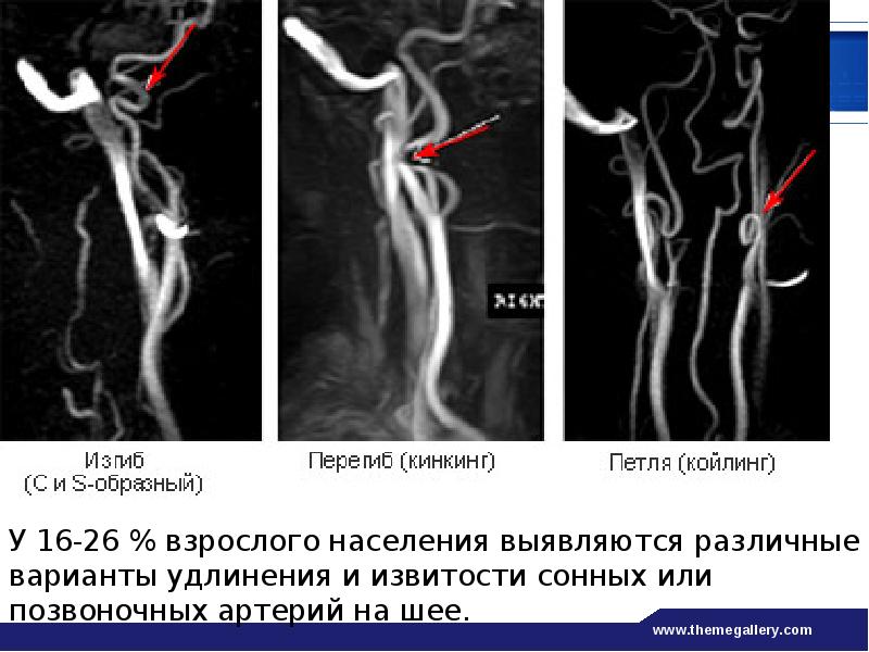 Аневризма сонной артерии шеи фото