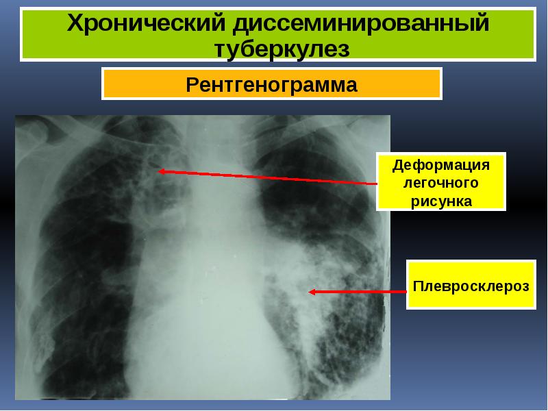 Легочный рисунок диффузно усилен что это значит у взрослого на рентгене