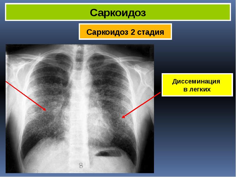 Саркоидоз фтизиатрия презентация