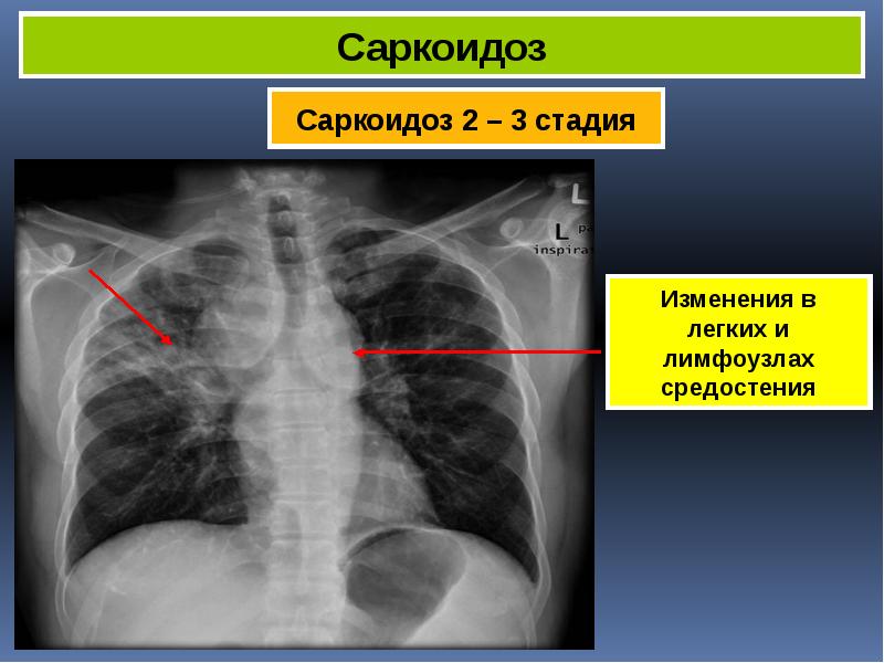 Саркоидоз фтизиатрия презентация