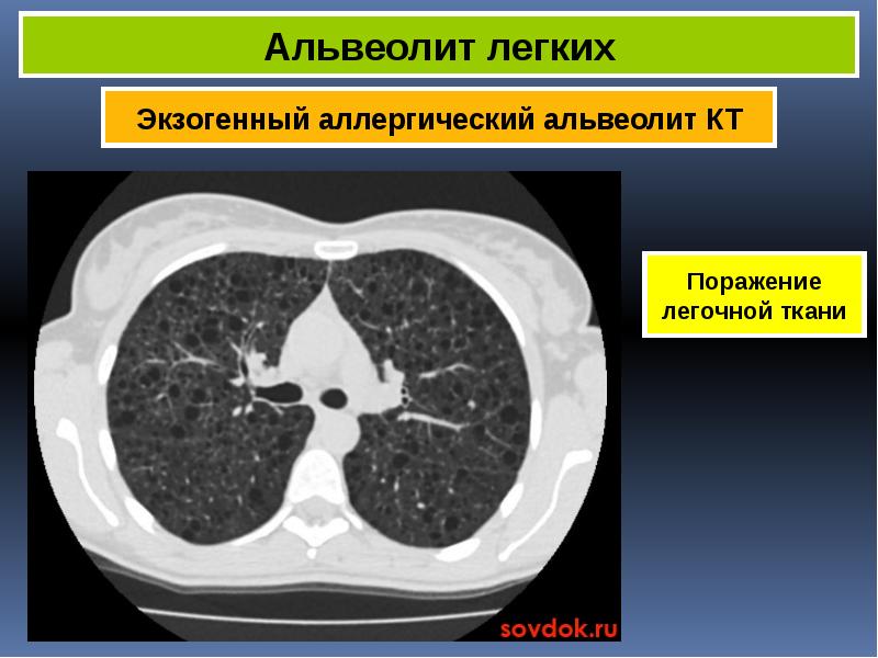 Альвеолиты легких презентация