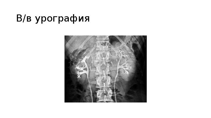 Внутривенная урография презентация