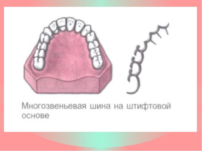 Шинирование зубов при ортопедическом лечении заболеваний пародонта презентация