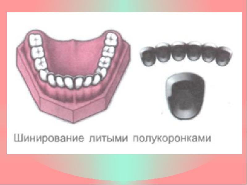 Постоянное шинирование при заболеваниях пародонта презентация