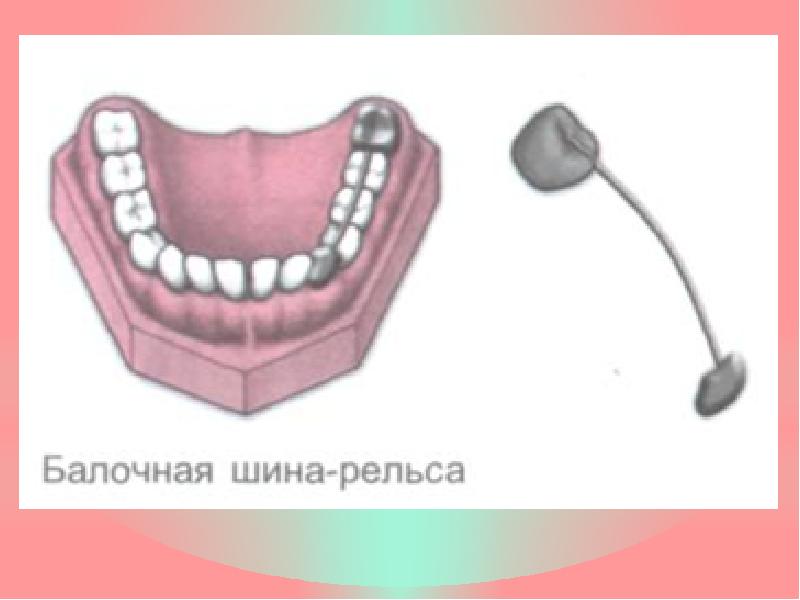 Постоянное шинирование при заболеваниях пародонта презентация