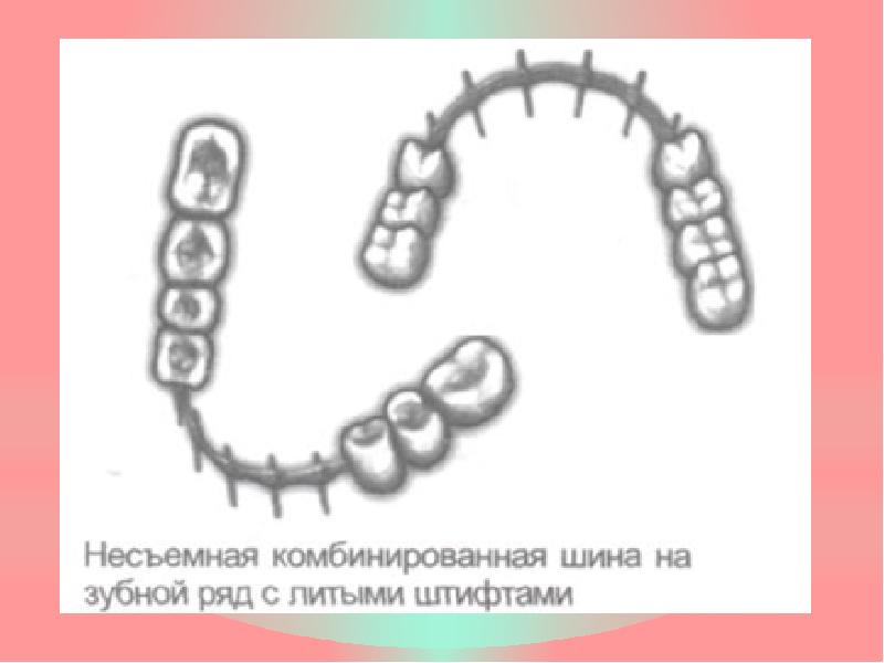 Шинирование зубов при ортопедическом лечении заболеваний пародонта презентация