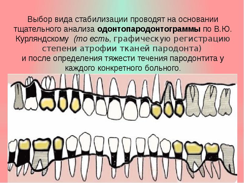 Постоянное шинирование при заболеваниях пародонта презентация