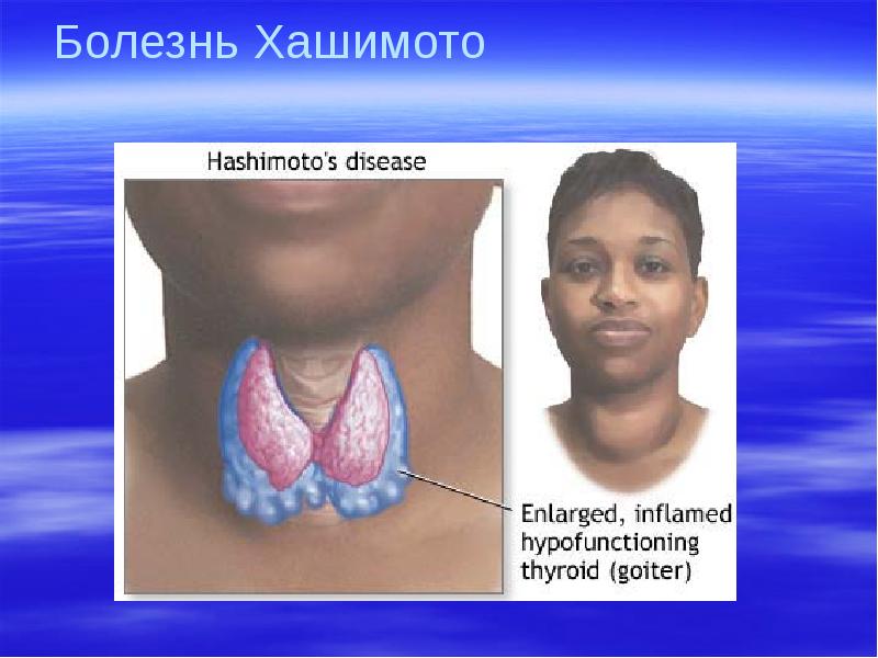 Тиреоидит хашимото презентация