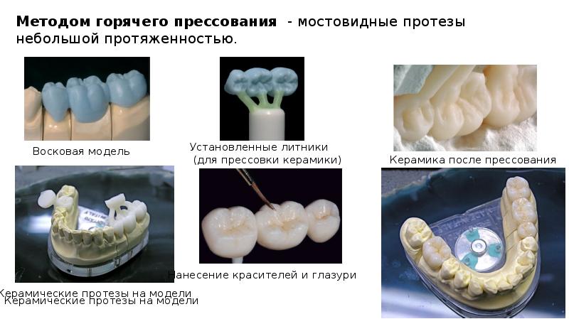 Изготовление мостовидных протезов презентация