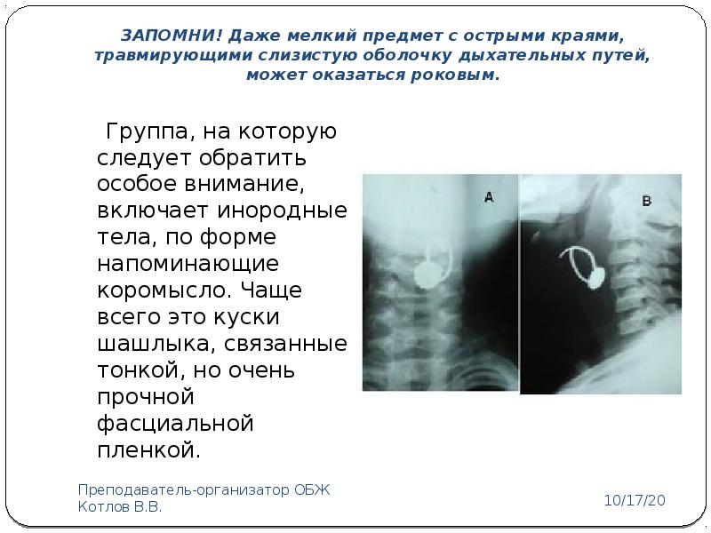 Инородные тела в верхних дыхательных путях презентация