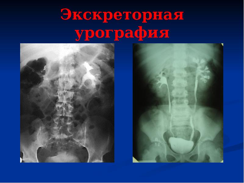 Хронический пиелонефрит карта вызова скорой