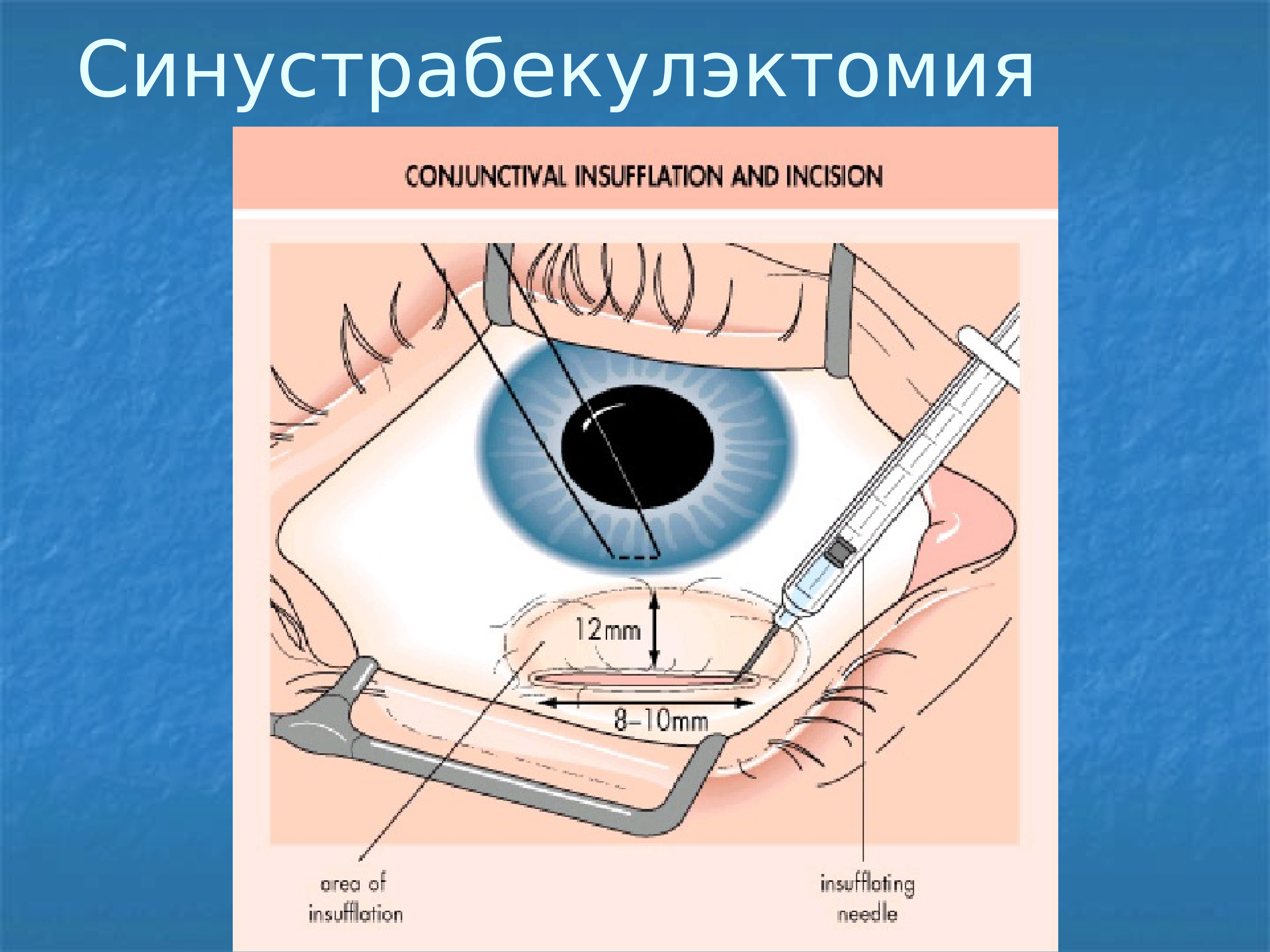 Описание операции. Синустрабекулэктомия осложнения. Синустрабекулэктомия осложнения после операции. Синустрабекулэктомия при глаукоме.