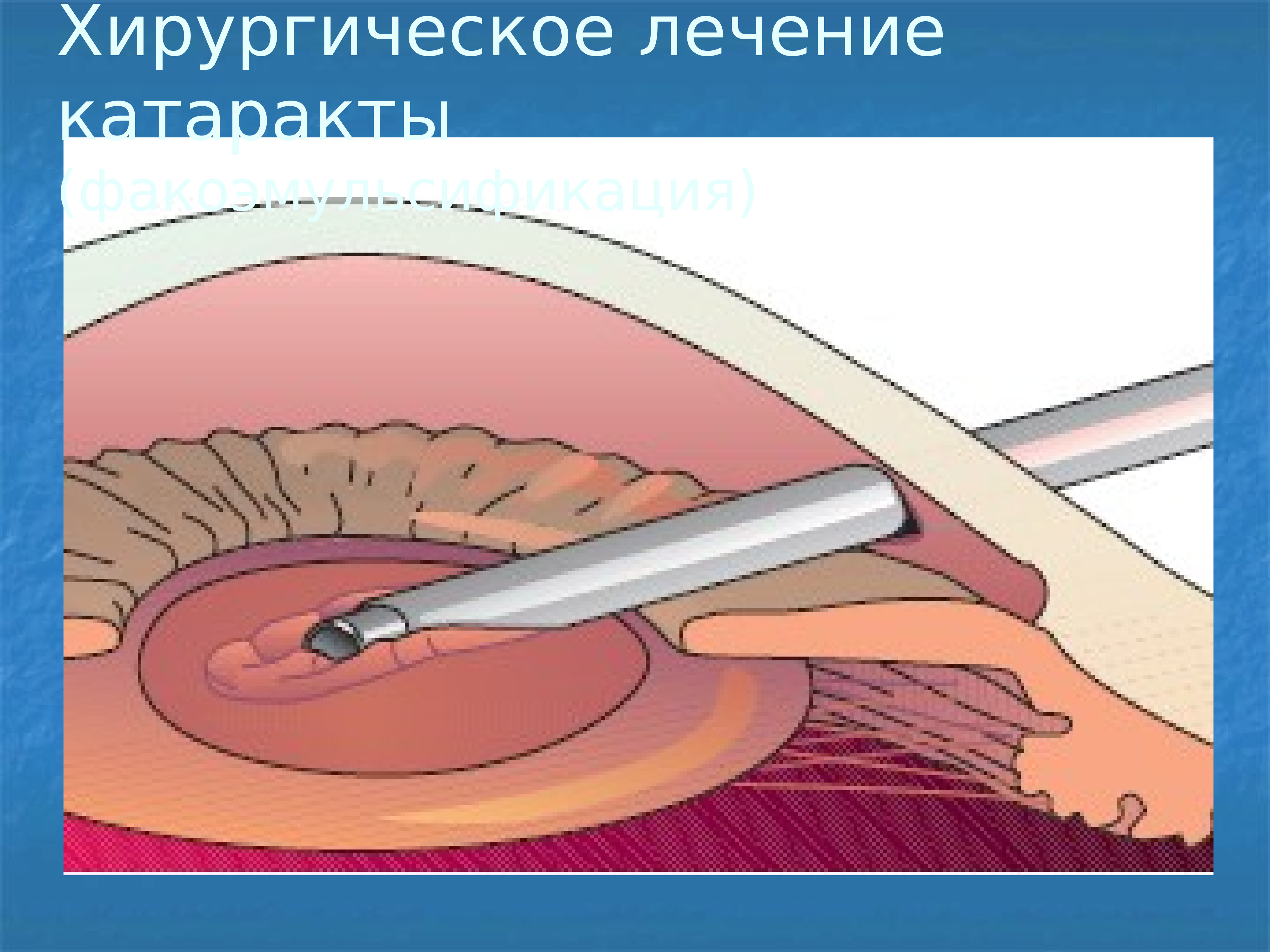 Ленсэктомия. Факоэмульсификация операция. Хирургическое лечение катаракты. Катаракта хирургическое лечение.