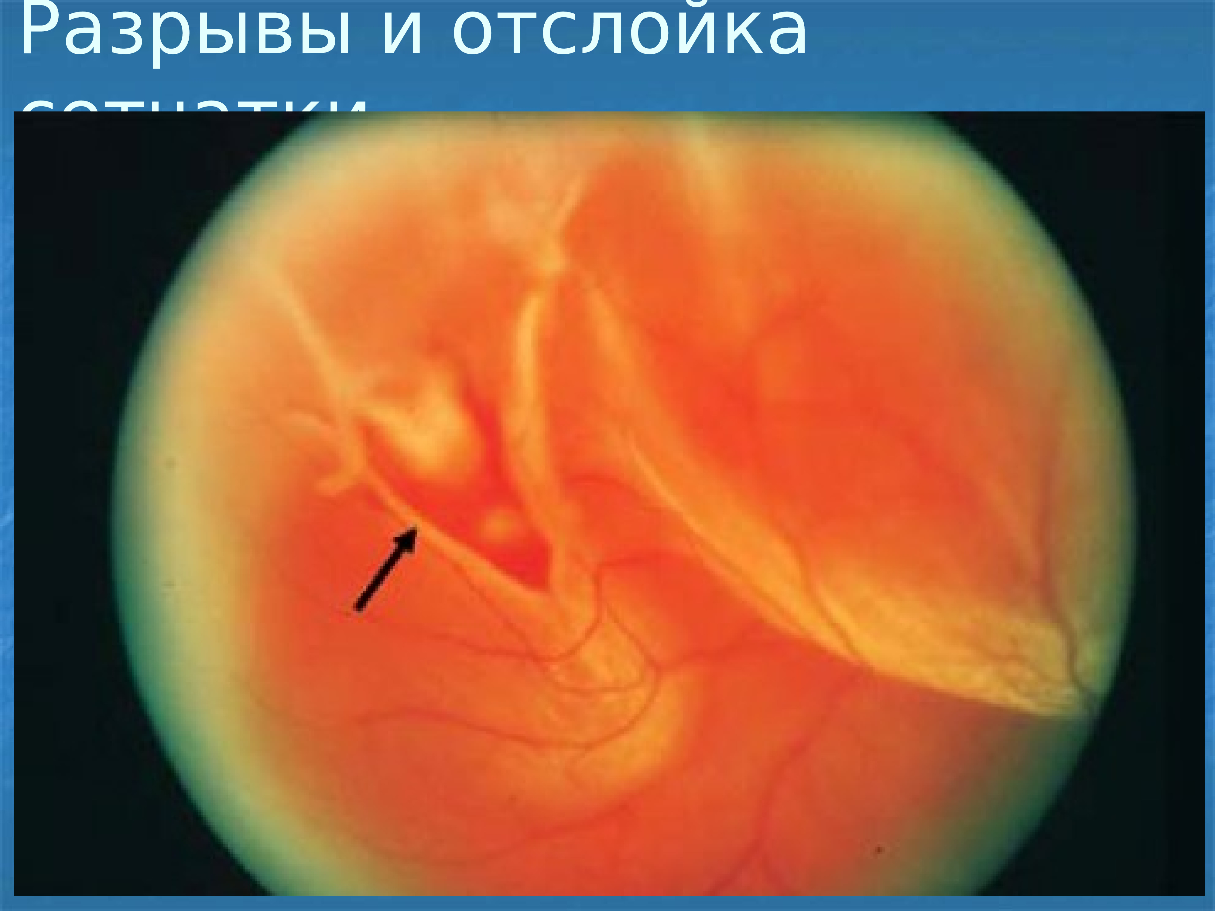Повреждение сетчатки. Отслойка сетчатки глазное дно. Экссудативная отслойка сетчатки. Отслойка пигментного эпителия. Биомикроскопия отслойка сетчатки.