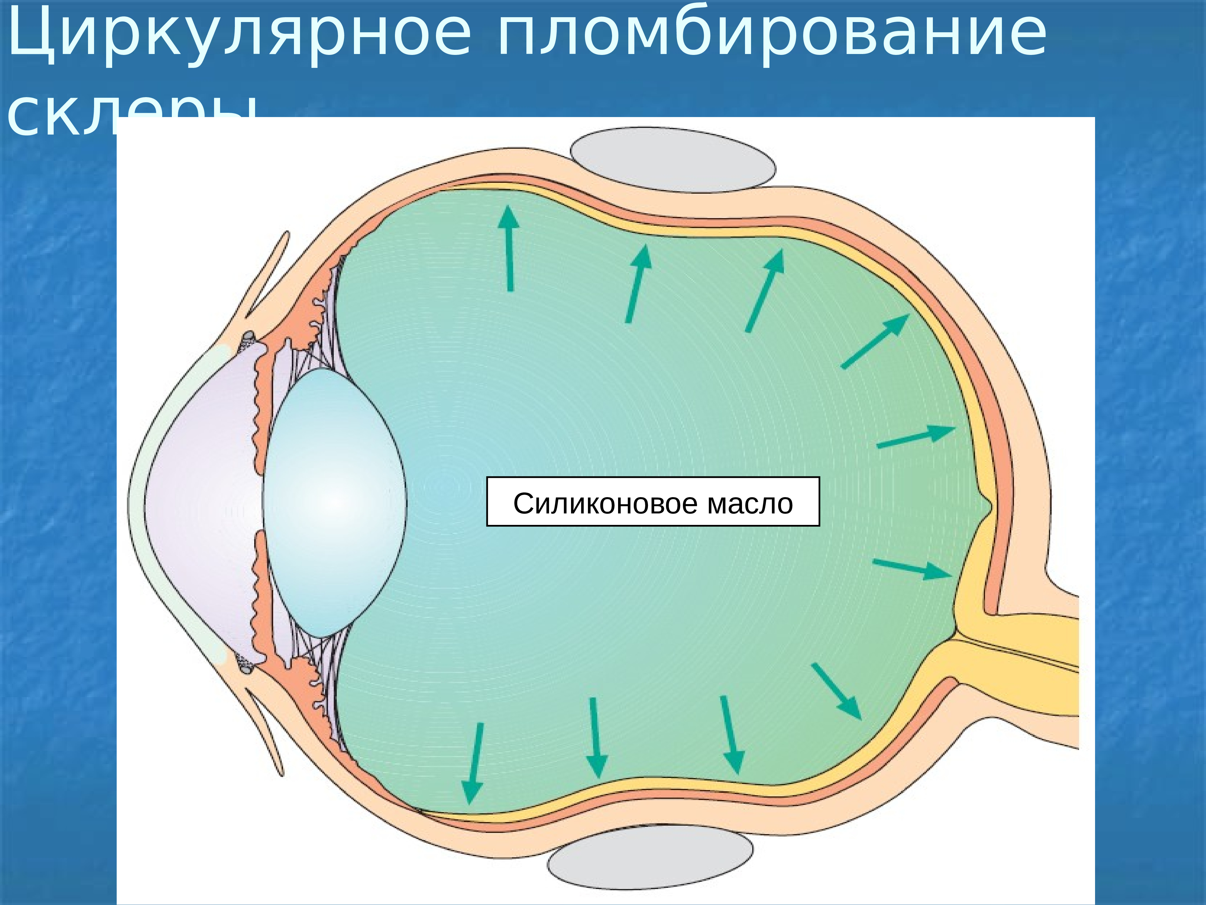 Циркляж