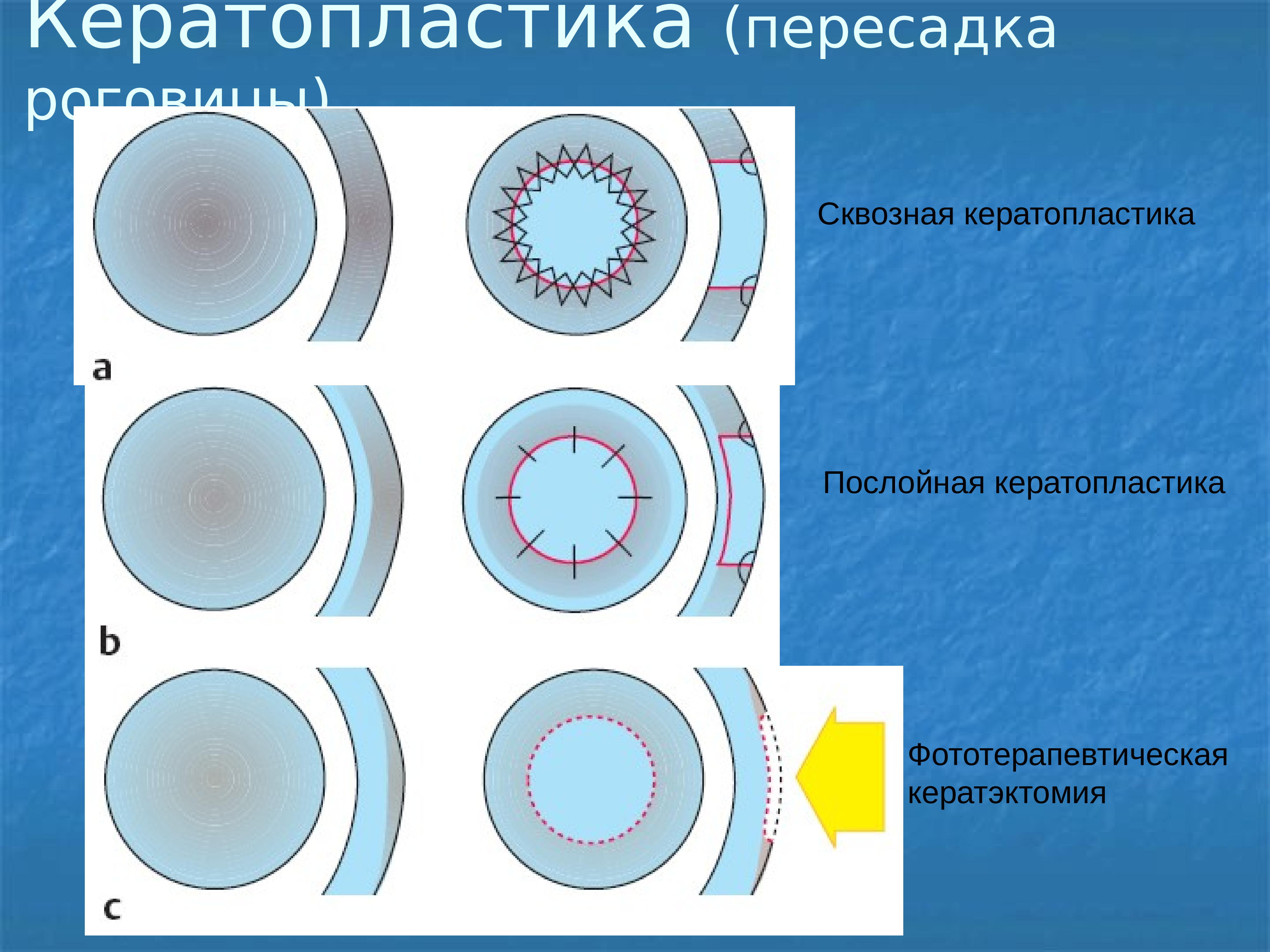 Кератопластика. Послойная кератопластика. Сквозная кератопластика. Оптическая кератопластика. Сквозная кератопластика схема.