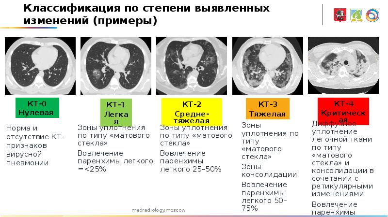 Что означает изменения в легких. Вирусная пневмония на кт. Кт стадии вирусной пневмонии. Компьютерная томография (кт) легких. Пневмония на кт.