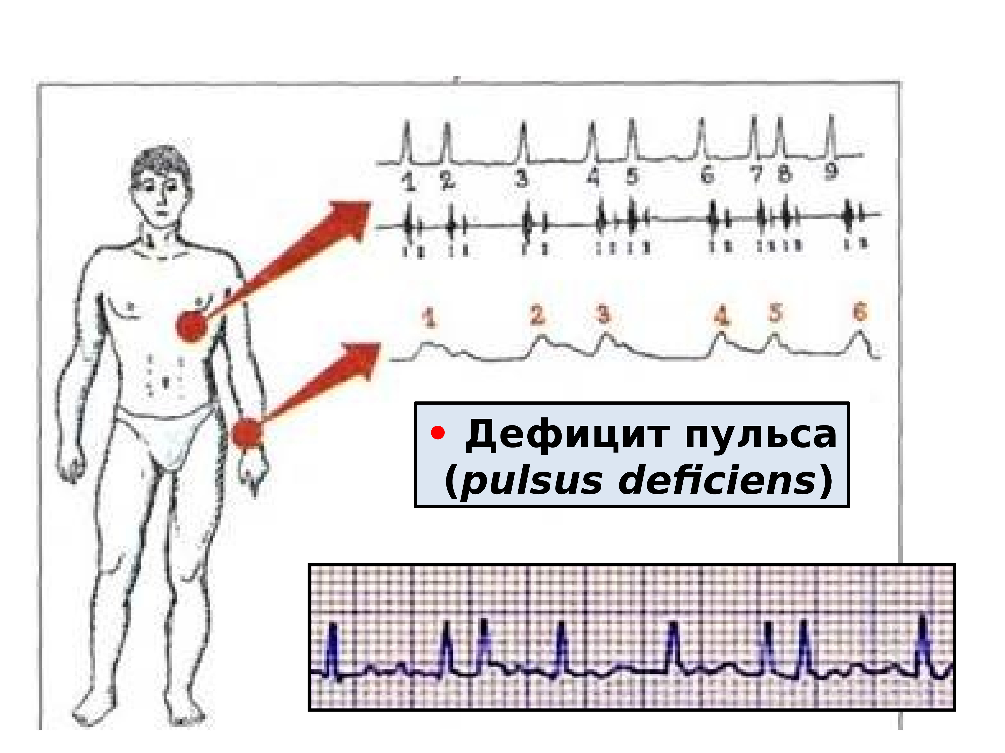 Дефицит пульса. Pulsus deficiens характерен для. Лечение дефицита пульса. Pulsus deficiens (дефицитный пульс) – это.