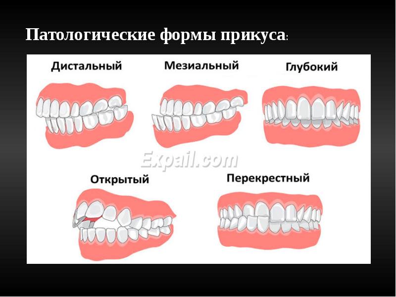 Виды окклюзии в стоматологии презентация