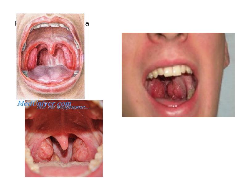 Катаральная ангина