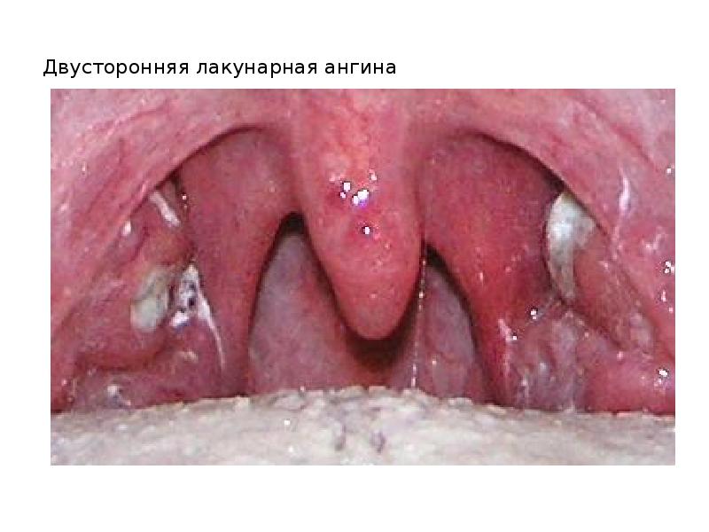 Двусторонняя лакунарная ангина