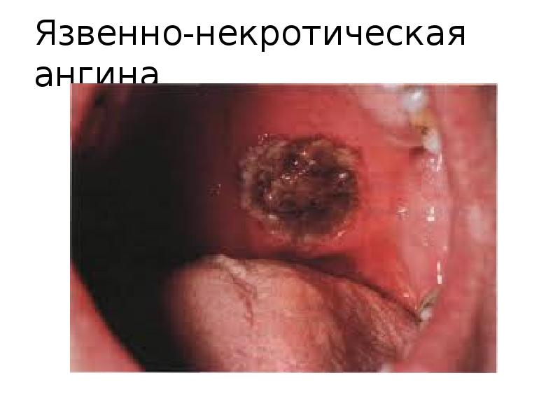 Язвенно-некротическая ангина