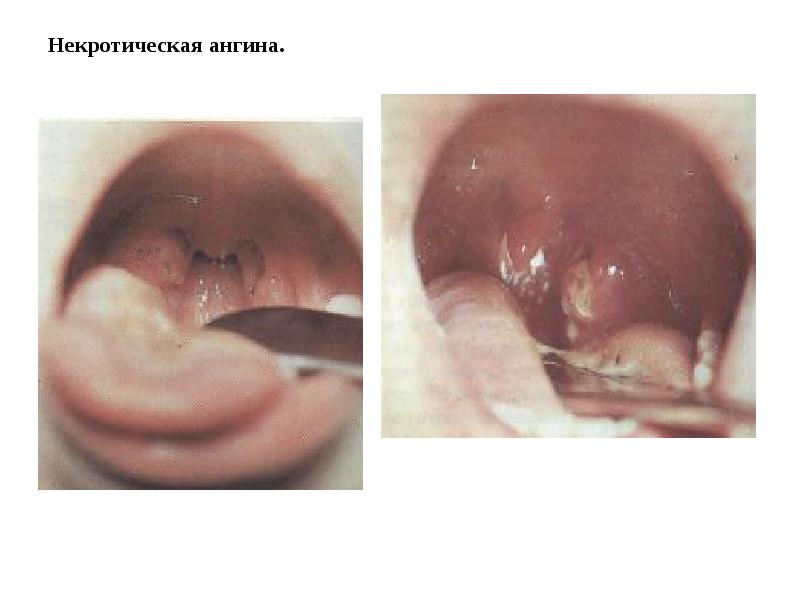 Некротическая ангина.