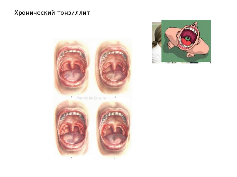 Хронический тонзиллит