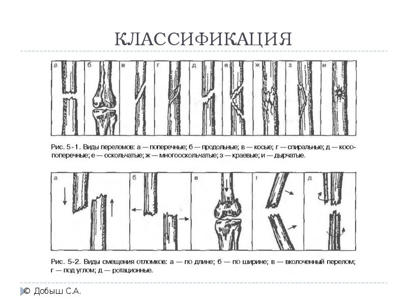 У образный перелом схема