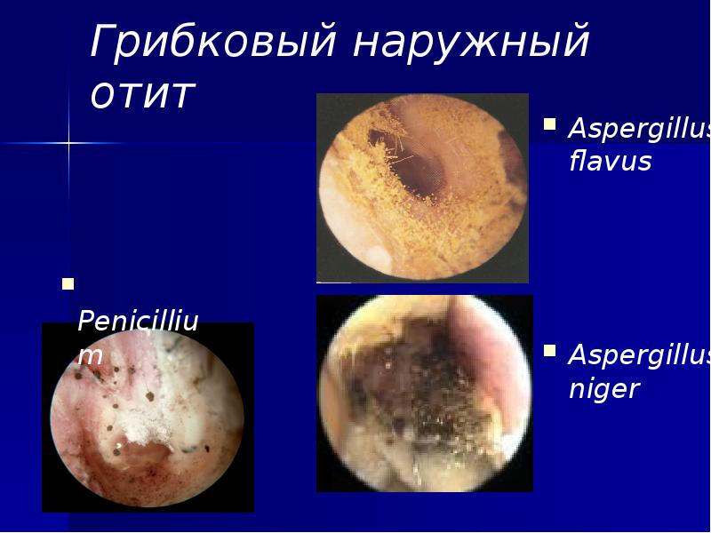 Грибковый наружный отит Aspergillus flavus     Aspergillus niger