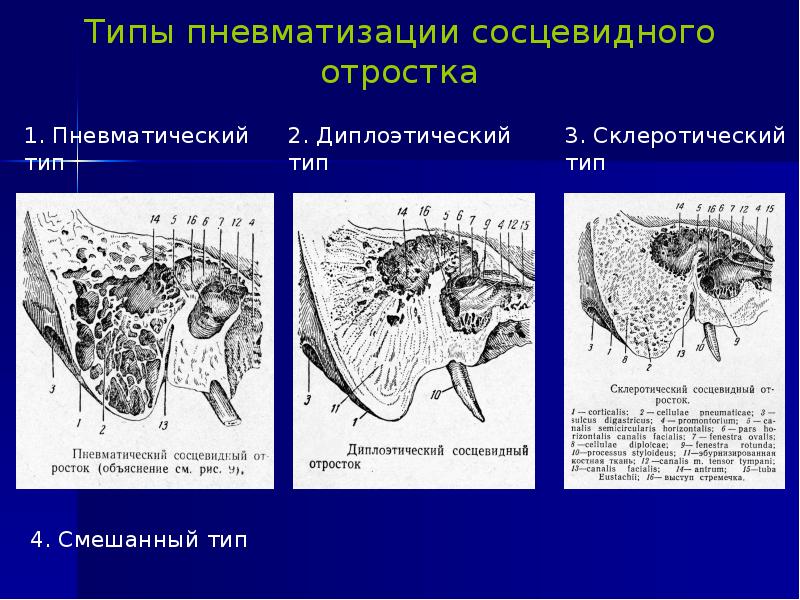 Типы пневматизации сосцевидного отростка