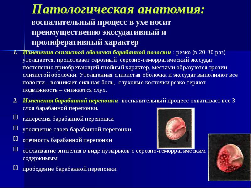 Патологическая анатомия: воспалительный процесс в ухе носит преимущественно экссудативный и пролиферативный