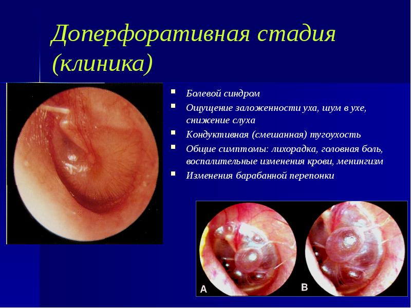 Доперфоративная стадия (клиника) Болевой синдром Ощущение заложенности уха, шум в ухе,
