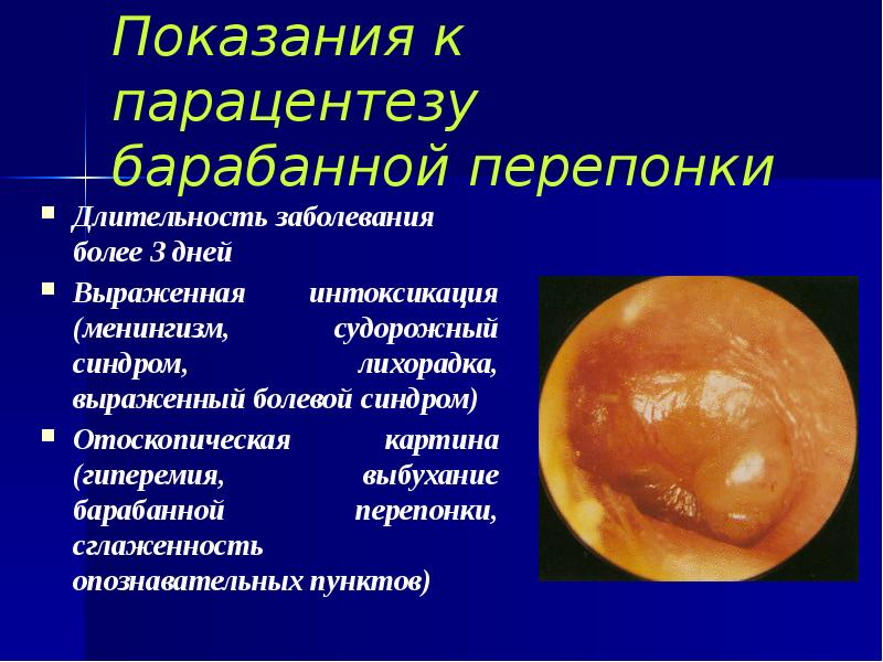 Показания к парацентезу барабанной перепонки Длительность заболевания более 3 дней Выраженная