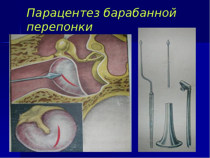 Парацентез барабанной перепонки