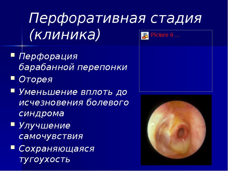 Перфоративная стадия (клиника) Перфорация барабанной перепонки Оторея Уменьшение вплоть до исчезновения