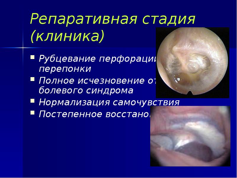 Репаративная стадия (клиника) Рубцевание перфорации барабанной перепонки Полное исчезновение отореи и