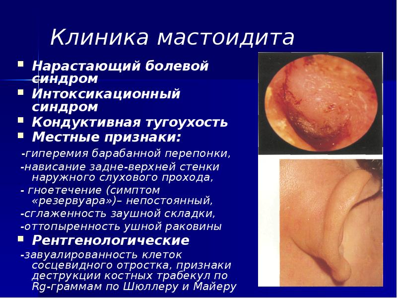 Клиника мастоидита Нарастающий болевой синдром Интоксикационный синдром Кондуктивная тугоухость Местные признаки: