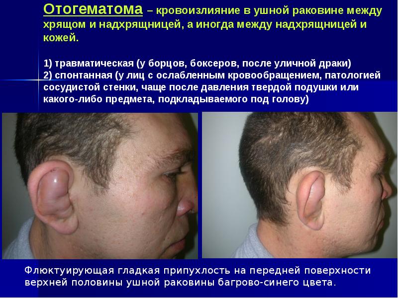Отогематома – кровоизлияние в ушной раковине между хрящом и надхрящницей, а