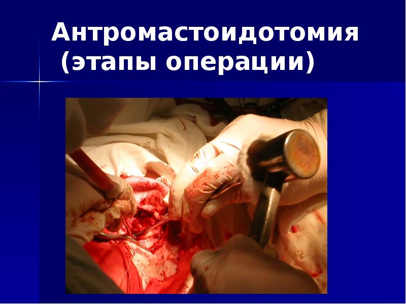 Антромастоидотомия  (этапы операции)